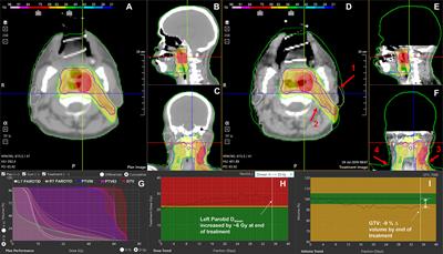 Retrospective Clinical Evaluation of a Decision-Support Software for Adaptive Radiotherapy of Head and Neck Cancer Patients